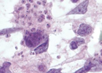 Encuentran parásitos en cerebro de un migrante salvadoreño en Estados Unidos