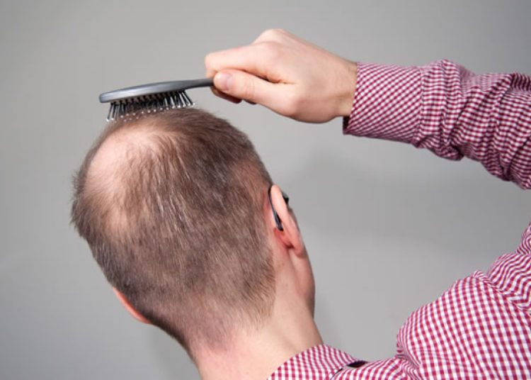 Descubren medicamento para tratar la calvicie