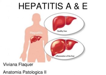 Ministerio de Salud revela brote de hepatitis “A” en Sonsonate