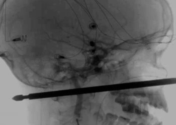 Un pincho de carne atraviesa la cabeza de un niño y este fue su final