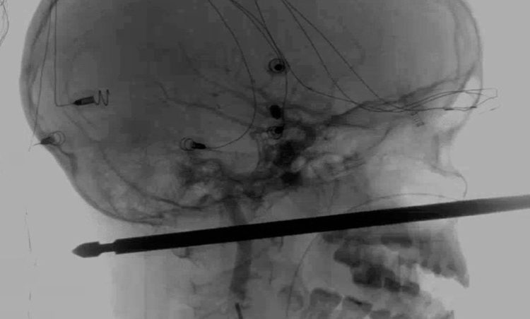 Un pincho de carne atraviesa la cabeza de un niño y este fue su final