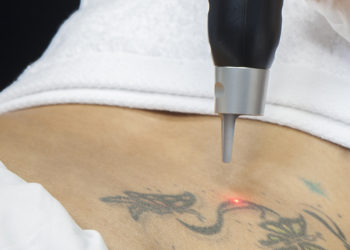 Decide quitarse un tatuaje con las iniciales de su exesposa y obtiene un terrible resultado