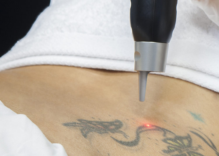 Decide quitarse un tatuaje con las iniciales de su exesposa y obtiene un terrible resultado