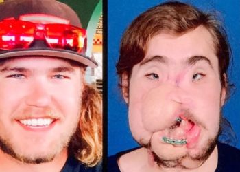 El trasplante de cara que cambió la vida de un joven luego de intentar suicidarse