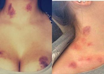 Los chupetones durante el sexo son peligrosos