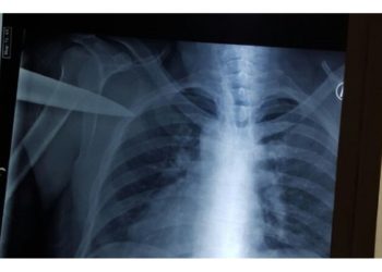 (VIDEO) Paciente con un cuchillo clavado en la espalda sale de un hospital porque quería fumar