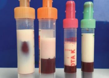 Extraen de un paciente diabético sangre completamente blanca por la grasa, que estuvo cerca de matarlo