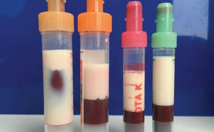 Extraen de un paciente diabético sangre completamente blanca por la grasa, que estuvo cerca de matarlo