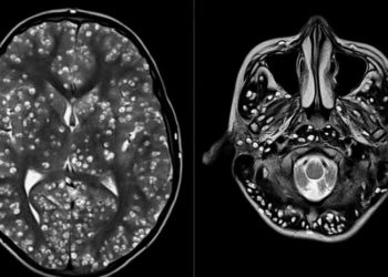 Acude al hospital con un fuerte dolor de cabeza y le hallan una plaga de larvas en el cerebro