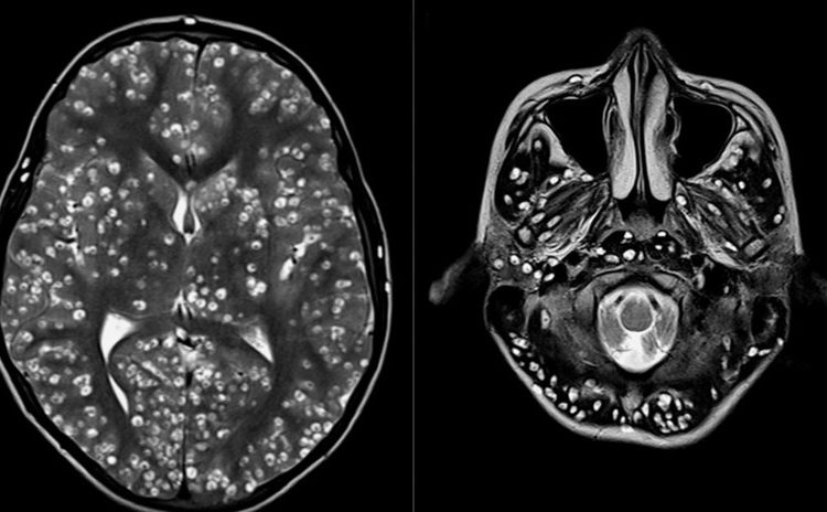 Acude al hospital con un fuerte dolor de cabeza y le hallan una plaga de larvas en el cerebro