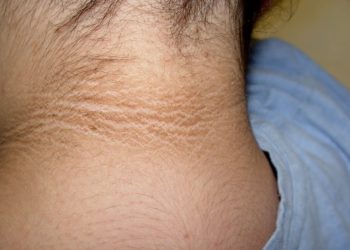 ¿Qué hacer o qué riesgo representa el oscurecimiento de la parte posterior del cuello?