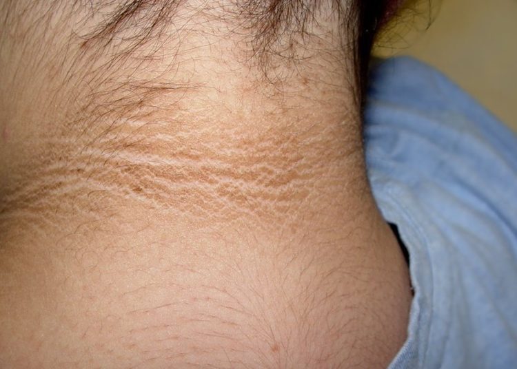 ¿Qué hacer o qué riesgo representa el oscurecimiento de la parte posterior del cuello?