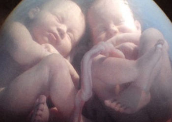 Mujer da a luz a gemelos de diferentes padres: uno de su marido y otro de su amante. ¿Cómo fue posible?