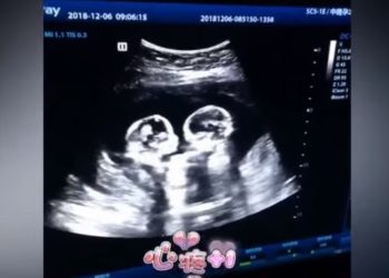 (VIDEO) Ecografía capta la «pelea» de unas gemelas en el vientre de su madre