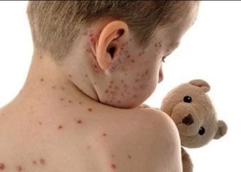 Sube a 704 los casos de sarampión en Estados Unidos, el más alto en 25 años