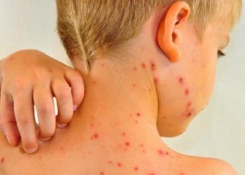 Aumentan en 300% los casos de sarampión en el mundo