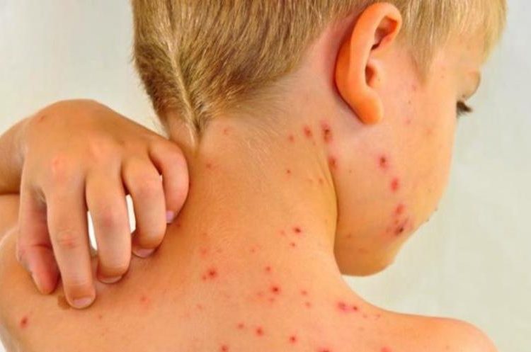 Aumentan en 300% los casos de sarampión en el mundo