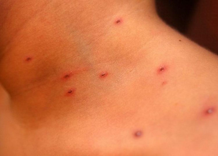 Intensifican vigilancia ante rumor de caso sospechoso de sarampión en El Salvador