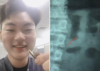 Se tragó un audífono mientras dormía y escuchó sonidos desde su estómago