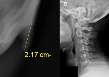 Por el uso continuo de los “smartphones” crece un cuerno en el cráneo humano