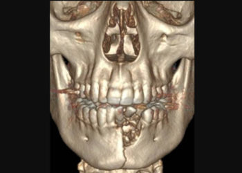 Un cigarrillo electrónico explota y le destroza la mandíbula a un adolescente