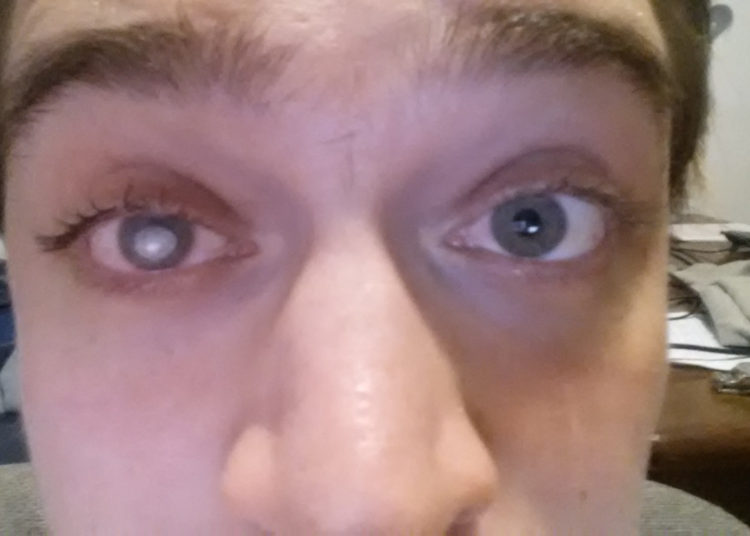 Futbolista británico pierde parte de la vista por bañarse con lentes de contacto