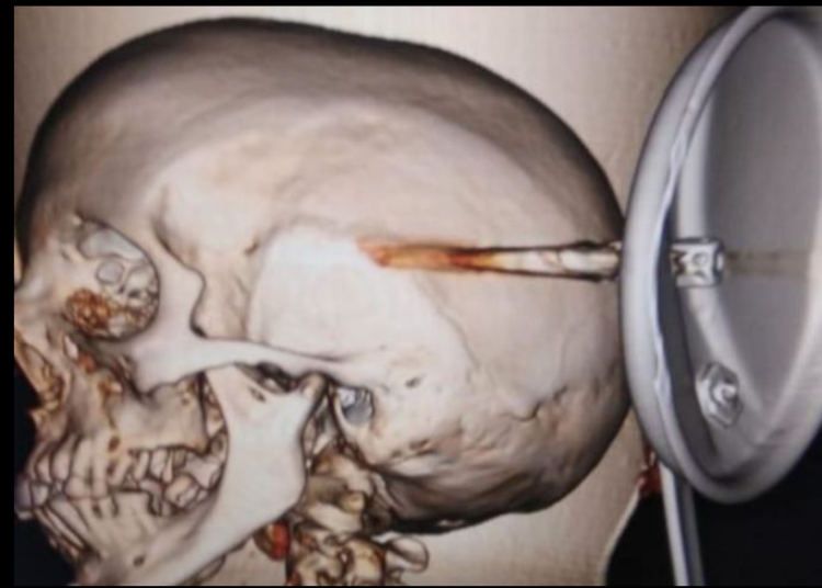 Un mujer tropieza y se incrusta en la cabeza la tapadera de una olla a presión