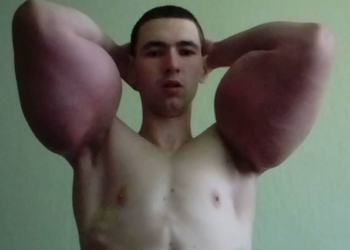 Fisicoculturista ruso se inyectó aceite en los brazos, ahora pide ayuda para operarse