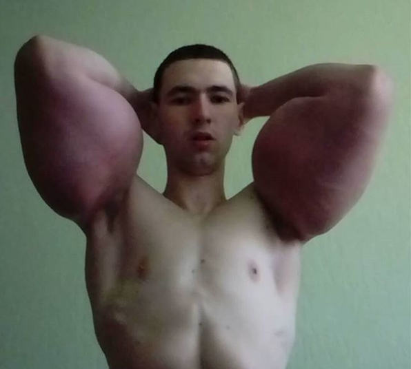 Fisicoculturista ruso se inyectó aceite en los brazos, ahora pide ayuda para operarse