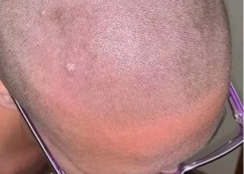 Mujer pierde el cabello por culpa de un acondicionador mezclado con crema depilatoria