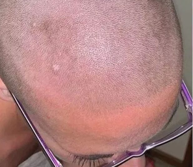 Mujer pierde el cabello por culpa de un acondicionador mezclado con crema depilatoria