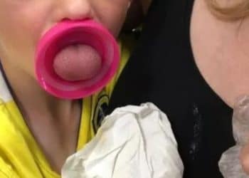 Policías del 911 de Sonsonate atendieron a una niña que atascó la lengua en un bote