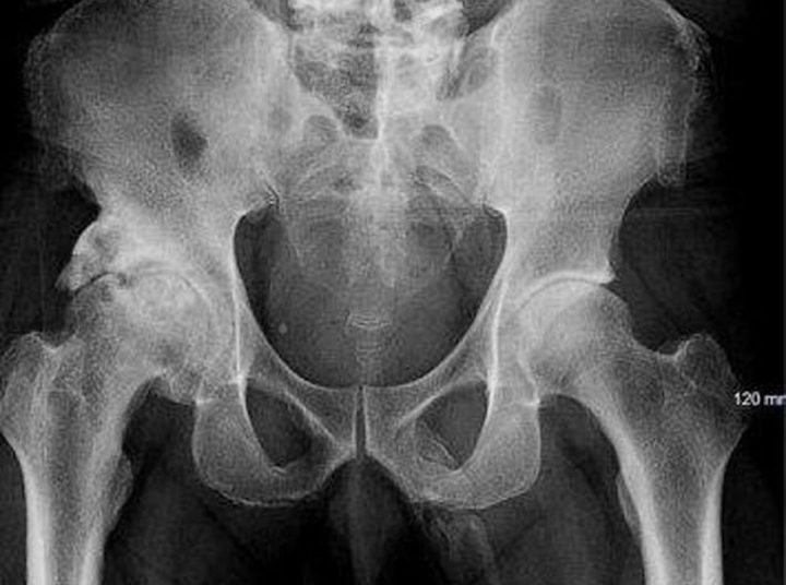 Un hombre sufre caída y al realizarse radiografía descubre algo raro en su pene