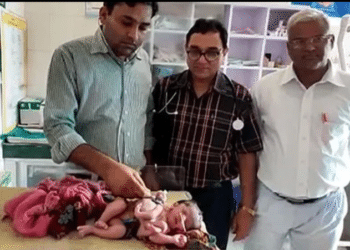 Nace bebé con 4 piernas y 3 manos en la India