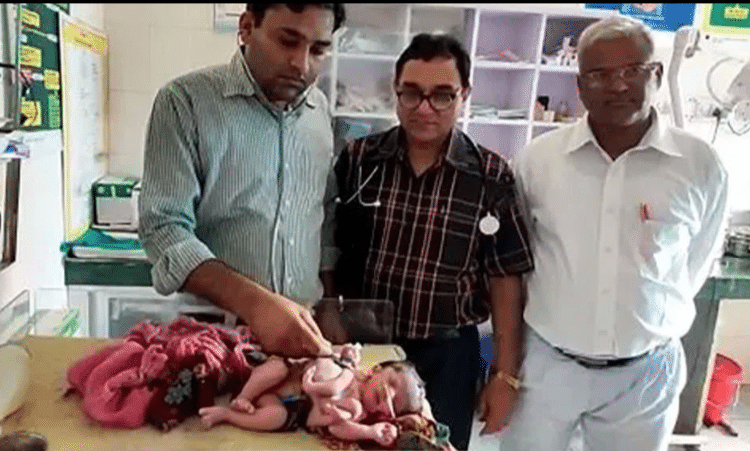 Nace bebé con 4 piernas y 3 manos en la India