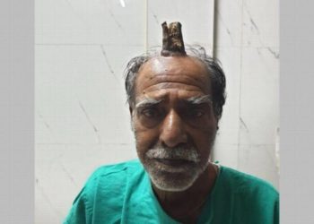 Un cuerno crece en la cabeza a un anciano de 74 años en la India