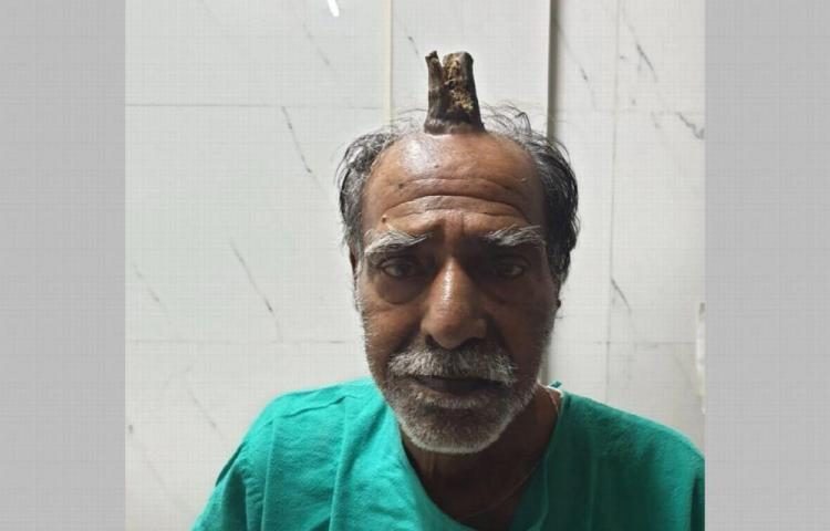 Un cuerno crece en la cabeza a un anciano de 74 años en la India
