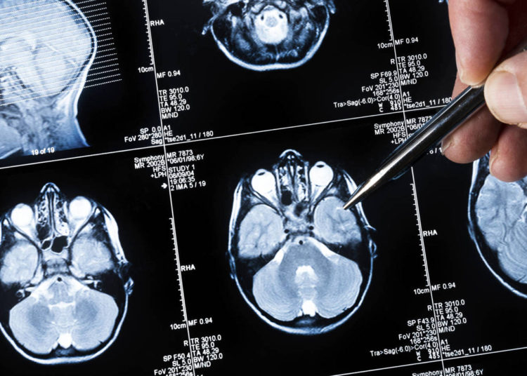 Registran oficialmente el primer medicamento contra el Alzheimer