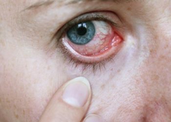 Acudió al médico por un fuerte dolor de ojos y le descubrieron una bacteria ‘come carne’