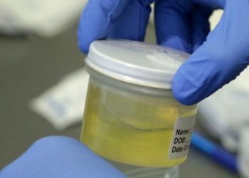 Una mujer tiene un raro síndrome que le hace orinar alcohol