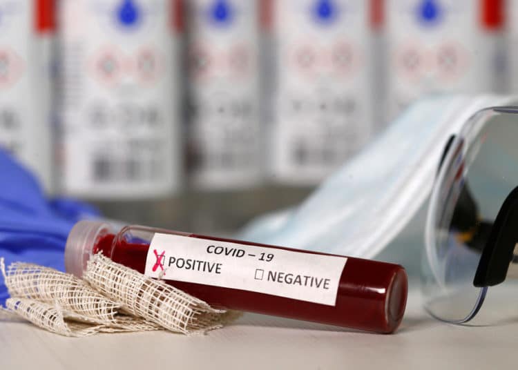 Anticuerpo generado por personas que tuvieron SARS podría neutralizar coronavirus