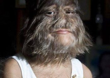 La niña más peluda del mundo se enamora y se afeita