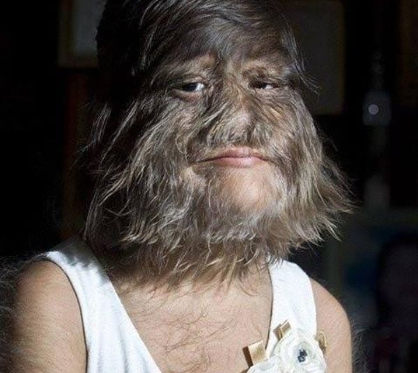 La niña más peluda del mundo se enamora y se afeita