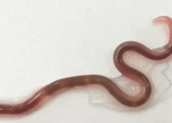 Extraen un gusano de 38 milímetros de la garganta de una mujer tras comer sashimi