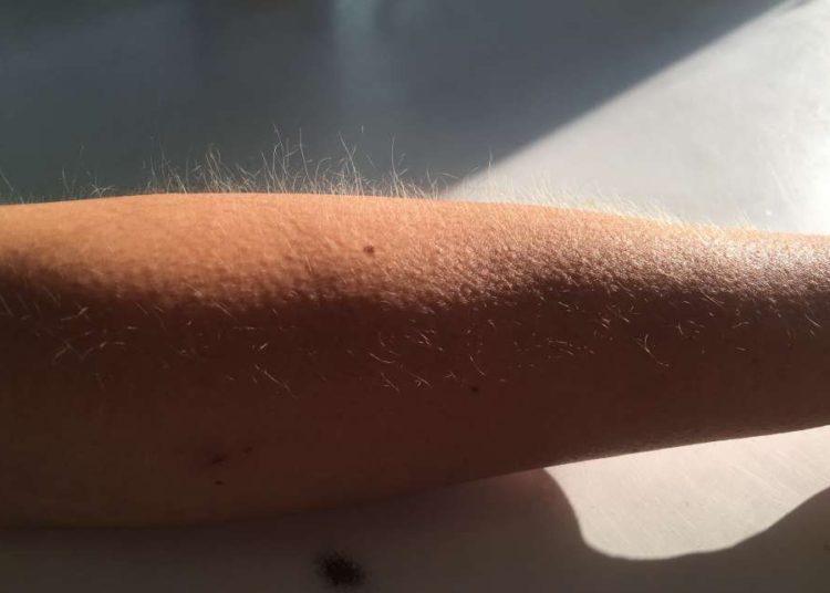 Descubren para qué se nos pone la piel de gallina