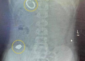 En Inglaterra un niño ingiere más de 50 imanes para averiguar si podía volverse magnético