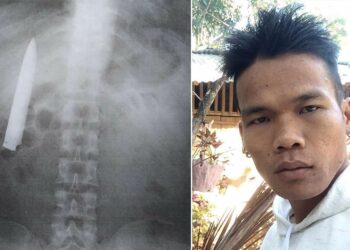 Un hombre descubre una hoja de cuchillo dentro de su torso 14 meses después de ser apuñalado