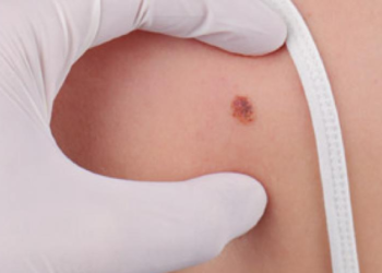 Día Mundial del Melanoma: Celebridades que han padecido esta enfermedad