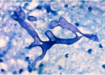 El estado indio de Jammu y Cachemira declara que el ‘hongo negro’ poscovid es una epidemia