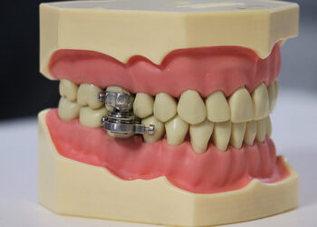 (VIDEO) Presentan el «primer dispositivo del mundo para adelgazar» cerrando los dientes con un ‘candado’